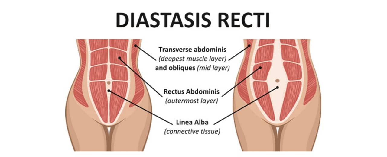 Symptoms, Causes & Treatment of Diastasis Recti