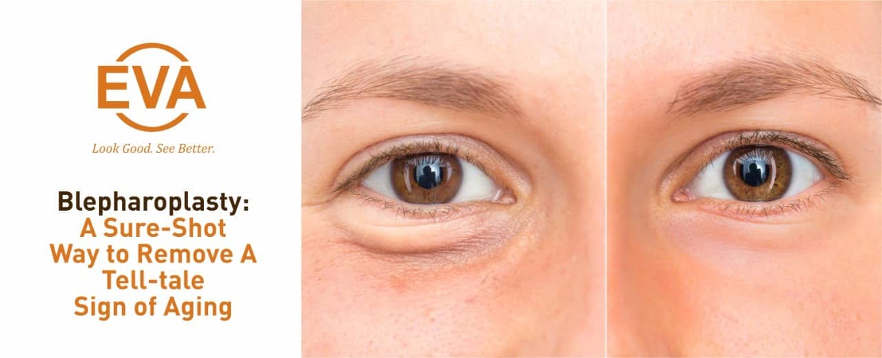 Blepharoplasty: A Sure-Shot Way to Remove A Tell-tale Sign of Aging