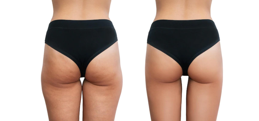 Affordable Brazilian Butt Lift Surgery Center at Delhi, India