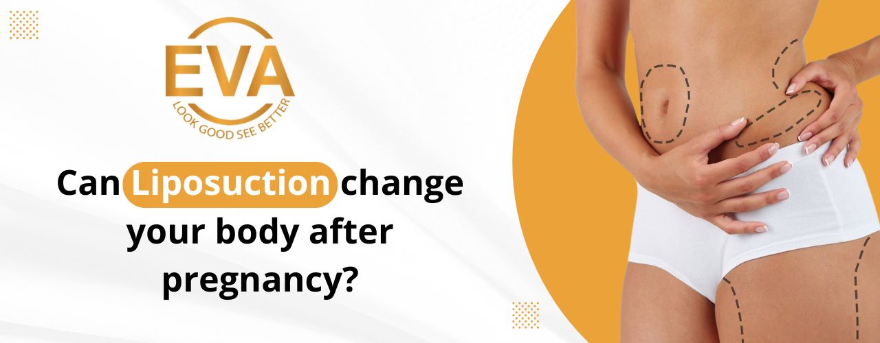 Can Liposuction change your body after pregnancy?